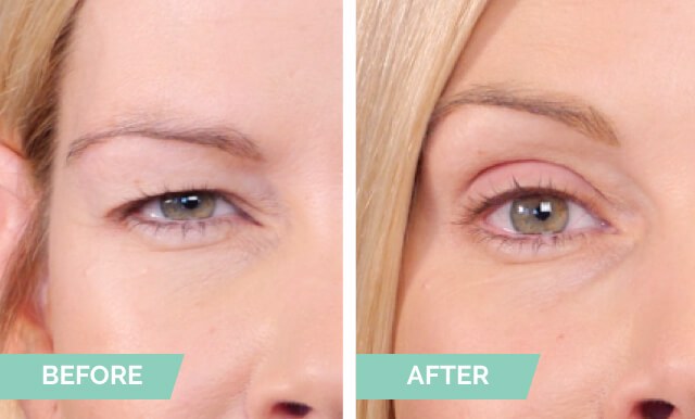 Natural Invisible Eyelid (90 Strips)